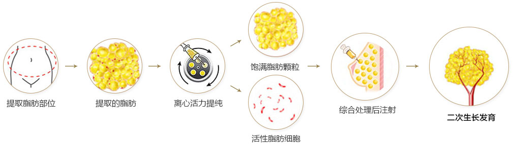 自体脂肪丰胸过程