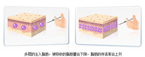 多层立体精确注射 